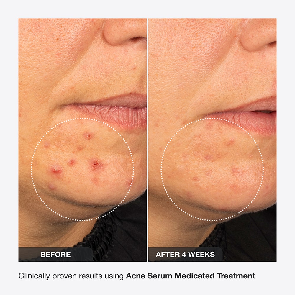 Innbeauty Project Acne Serum serum mot kviser