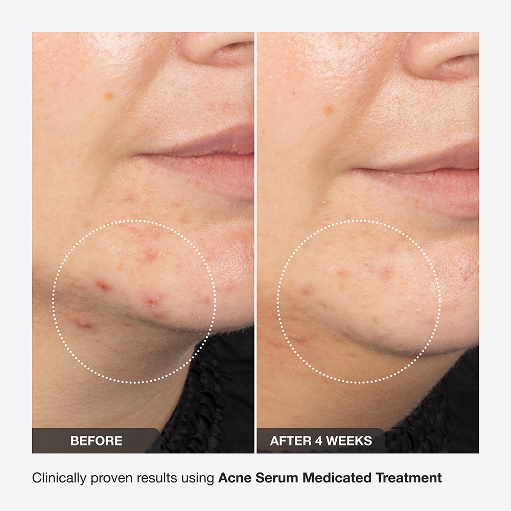 Innbeauty Project Acne Serum serum mot kviser