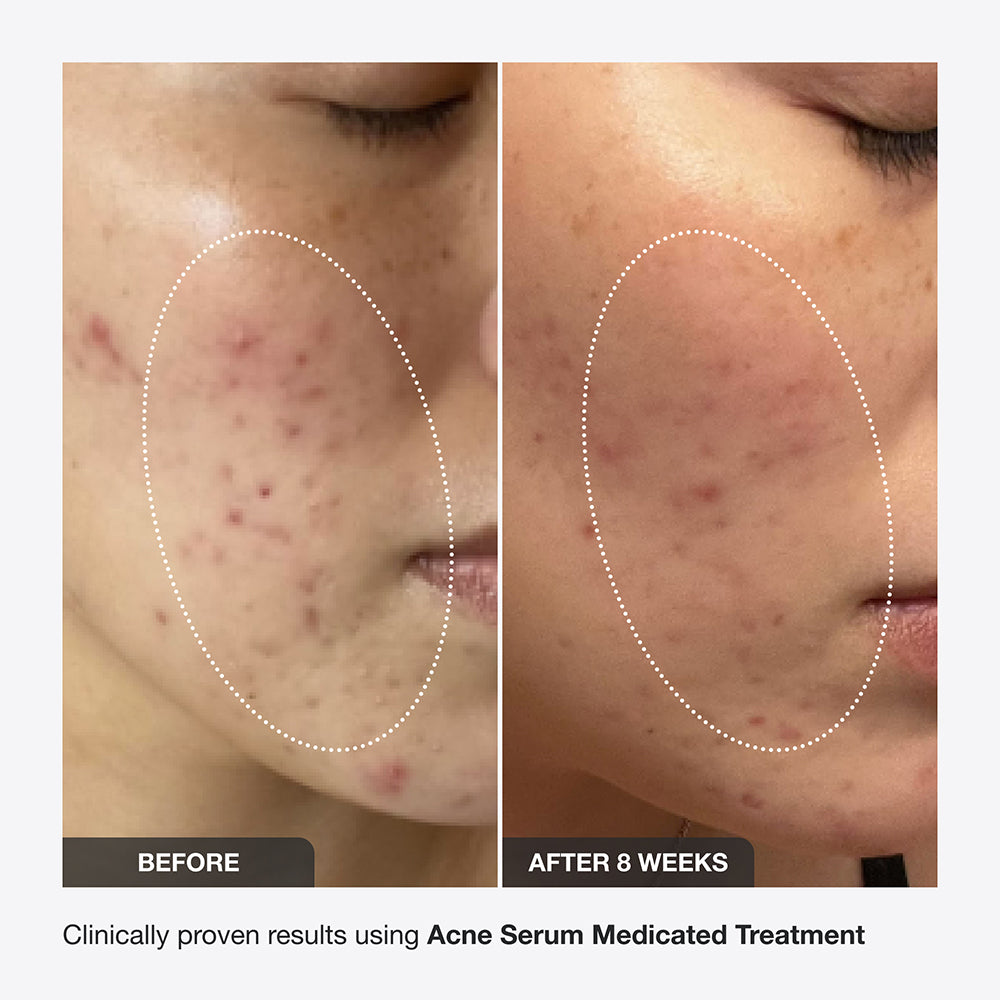 Innbeauty Project Acne Serum serum mot kviser